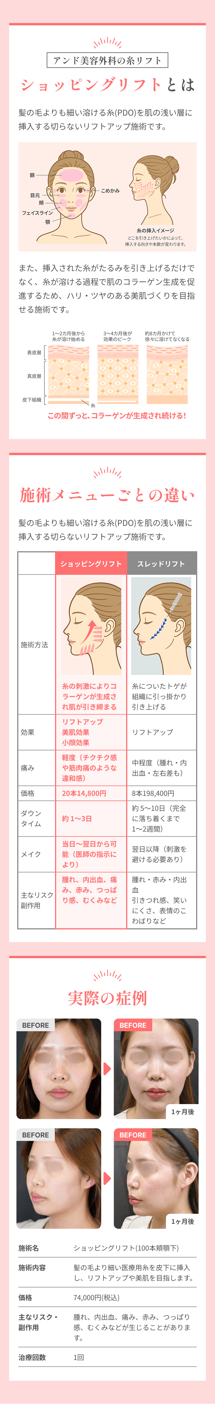 and(アンド)美容外科の糸リフト:ショッピングリフトとは髪の毛よりも細い溶ける糸(PDO)を肌の浅い層に挿入する切らないリフトアップ施術です。/ショッピングリフトとスレッドリフトの違い/実際の症例